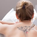 Tattoo Removal Treatments and Procedures