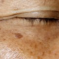 Hyperpigmentation Treatments: What You Need to Know