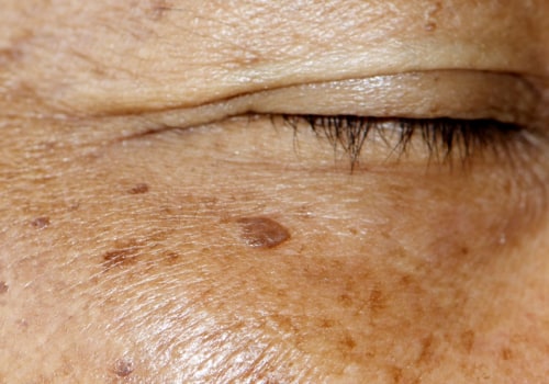 Hyperpigmentation Treatments: What You Need to Know
