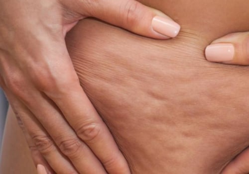 Cellulite Reduction Treatments: What You Need to Know